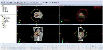 Unsupervised machine learning model for detecting anomalous volumetric modulated arc therapy plans for lung cancer patients